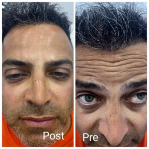 بوتوكس الجبهة في رأس غارب